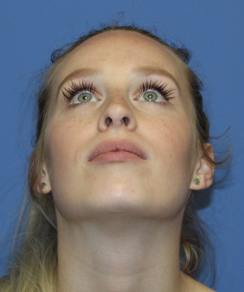 Revision Rhinoplasty 4909 – Click HERE for more views before photo. Individual results may vary.