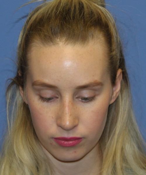 Revision Rhinoplasty 4909 – Click HERE for more views after photo. Individual results may vary.