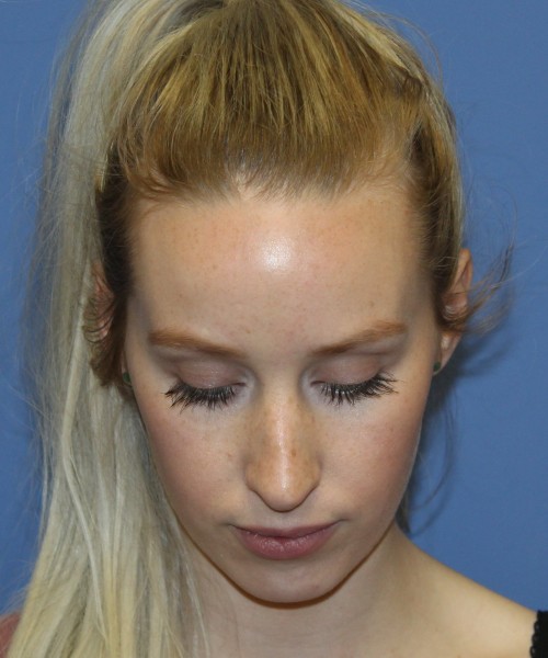Revision Rhinoplasty 4909 – Click HERE for more views before photo. Individual results may vary.
