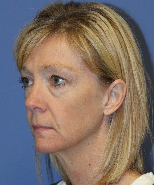 Blepharoplasty (eyelids) 4926 – Click HERE for more views. before photo. Individual results may vary.
