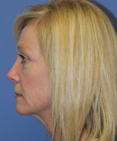 Blepharoplasty (eyelids) 4926 – Click HERE for more views. after photo. Individual results may vary.