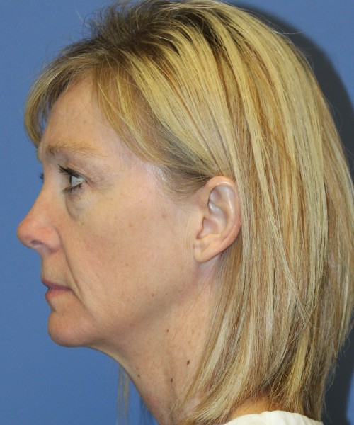Blepharoplasty (eyelids) 4926 – Click HERE for more views. before photo. Individual results may vary.