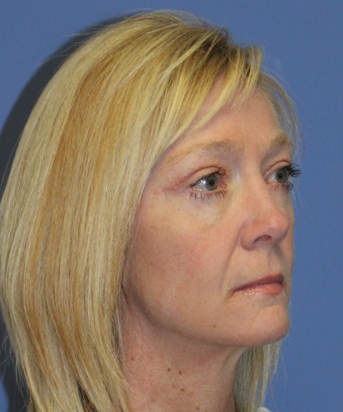 Blepharoplasty (eyelids) 4926 – Click HERE for more views. after photo. Individual results may vary.