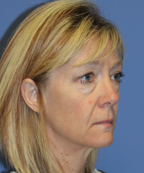Blepharoplasty (eyelids) 4926 – Click HERE for more views. before photo. Individual results may vary.