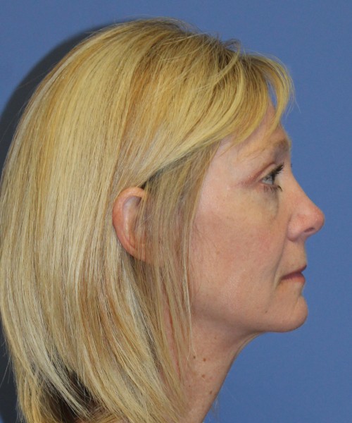 Blepharoplasty (eyelids) 4926 – Click HERE for more views. after photo. Individual results may vary.