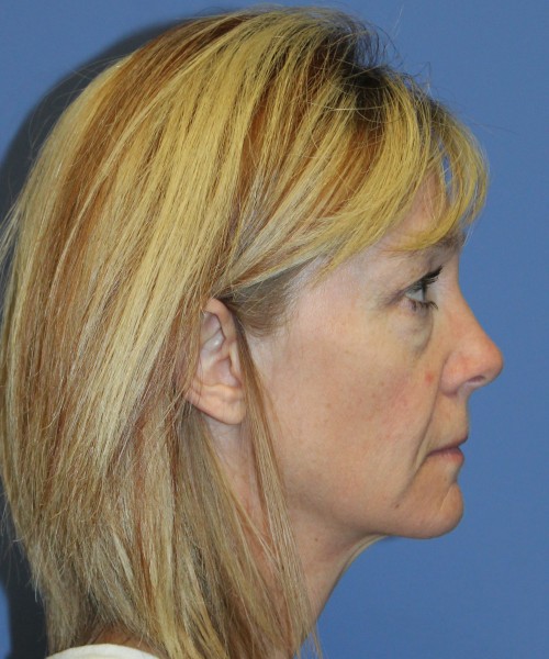 Blepharoplasty (eyelids) 4926 – Click HERE for more views. before photo. Individual results may vary.