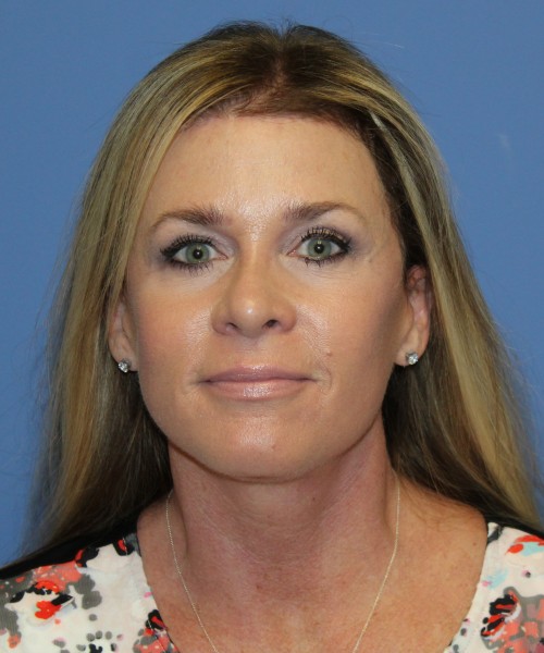 Facelift, Browlift, Lip Augmentation 4982 – Click HERE for more views after photo. Individual results may vary.