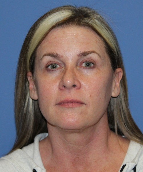 Facelift, Browlift, Lip Augmentation 4982 – Click HERE for more views before photo. Individual results may vary.