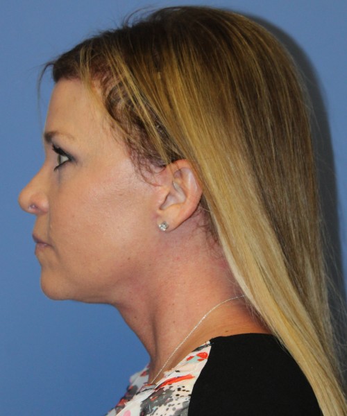 Facelift, Browlift, Lip Augmentation 4982 – Click HERE for more views after photo. Individual results may vary.