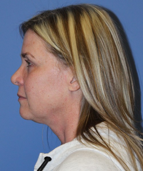 Facelift, Browlift, Lip Augmentation 4982 – Click HERE for more views before photo. Individual results may vary.