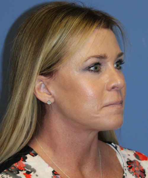 Facelift, Browlift, Lip Augmentation 4982 – Click HERE for more views after photo. Individual results may vary.