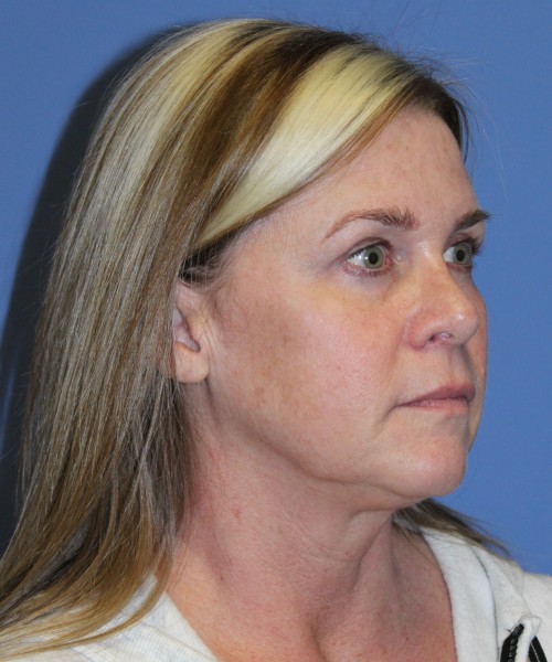 Facelift, Browlift, Lip Augmentation 4982 – Click HERE for more views before photo. Individual results may vary.