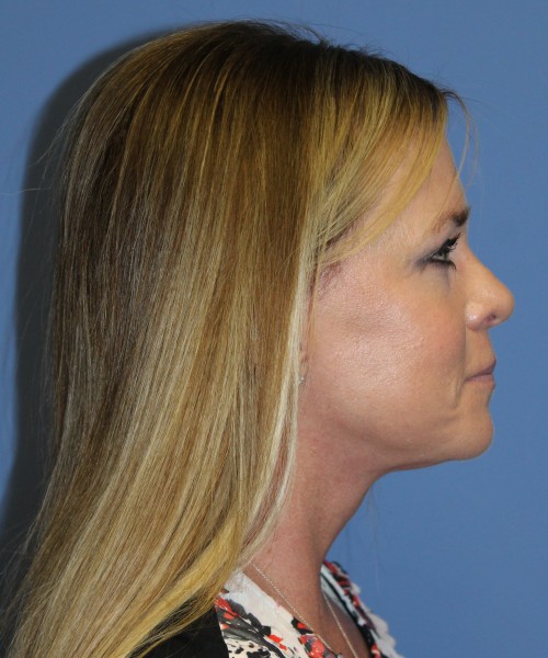Facelift, Browlift, Lip Augmentation 4982 – Click HERE for more views after photo. Individual results may vary.