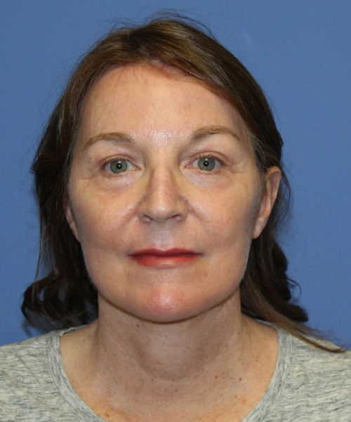 Facelift, Browlift, Lip Augmentation, Laser Skin Resurfacing 4994 – Click HERE for more views after photo. Individual results may vary.