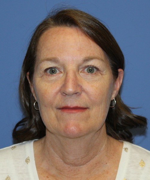 Facelift, Browlift, Lip Augmentation, Laser Skin Resurfacing 4994 – Click HERE for more views before photo. Individual results may vary.