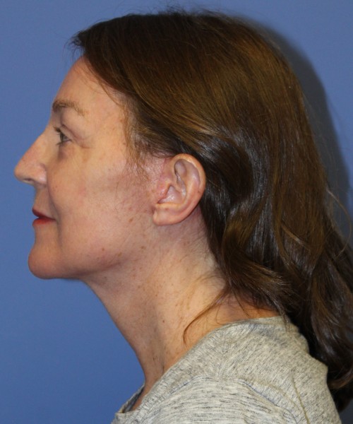 Facelift, Browlift, Lip Augmentation, Laser Skin Resurfacing 4994 – Click HERE for more views after photo. Individual results may vary.