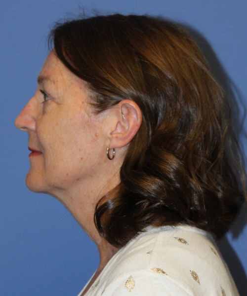 Facelift, Browlift, Lip Augmentation, Laser Skin Resurfacing 4994 – Click HERE for more views before photo. Individual results may vary.