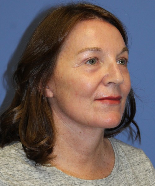 Facelift, Browlift, Lip Augmentation, Laser Skin Resurfacing 4994 – Click HERE for more views after photo. Individual results may vary.