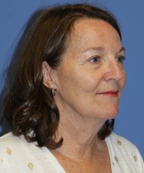 Facelift, Browlift, Lip Augmentation, Laser Skin Resurfacing 4994 – Click HERE for more views before photo. Individual results may vary.