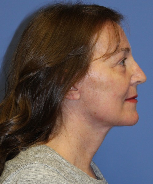 Facelift, Browlift, Lip Augmentation, Laser Skin Resurfacing 4994 – Click HERE for more views after photo. Individual results may vary.