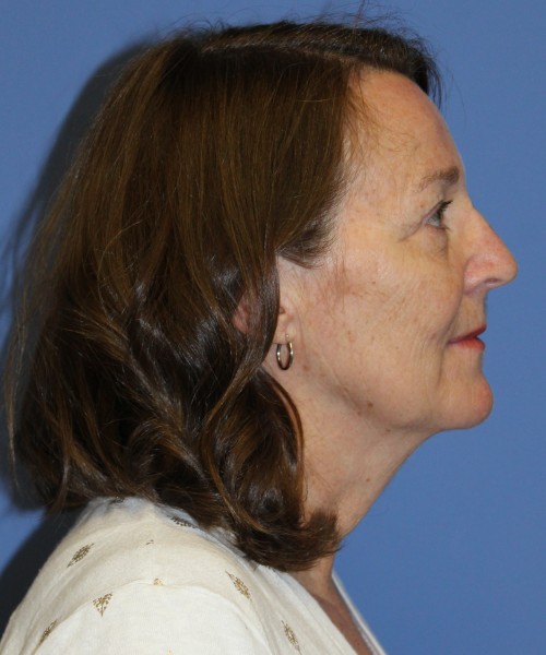 Facelift, Browlift, Lip Augmentation, Laser Skin Resurfacing 4994 – Click HERE for more views before photo. Individual results may vary.