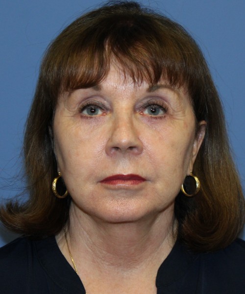 Facelift, Browlift, Lip Augmentation, Blepharoplasty 5033 – Click HERE for more views after photo. Individual results may vary.