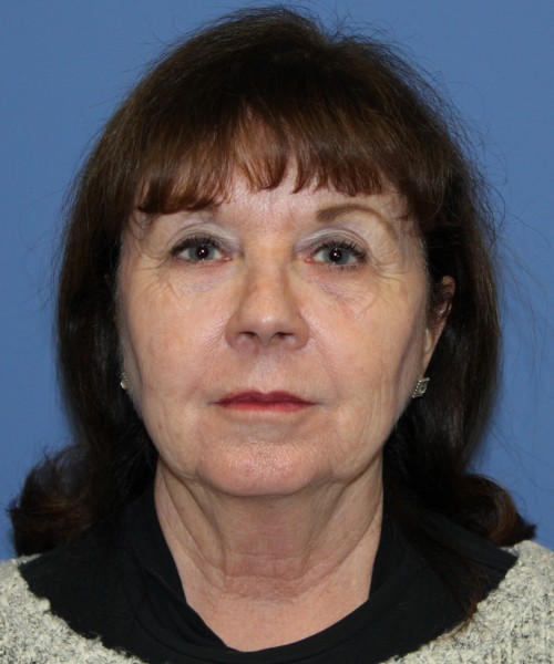 Facelift, Browlift, Lip Augmentation, Blepharoplasty 5033 – Click HERE for more views before photo. Individual results may vary.
