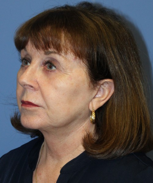 Facelift, Browlift, Lip Augmentation, Blepharoplasty 5033 – Click HERE for more views after photo. Individual results may vary.