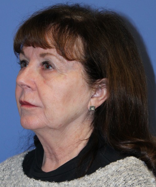 Facelift, Browlift, Lip Augmentation, Blepharoplasty 5033 – Click HERE for more views before photo. Individual results may vary.