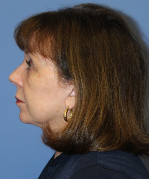 Facelift, Browlift, Lip Augmentation, Blepharoplasty 5033 – Click HERE for more views after photo. Individual results may vary.