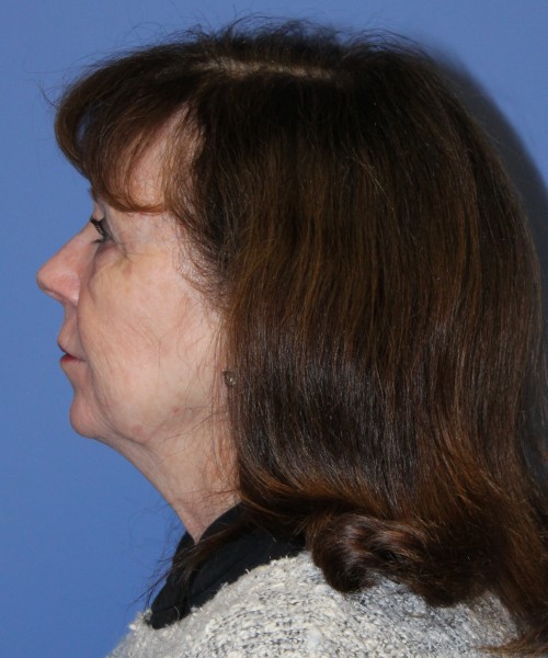 Facelift, Browlift, Lip Augmentation, Blepharoplasty 5033 – Click HERE for more views before photo. Individual results may vary.