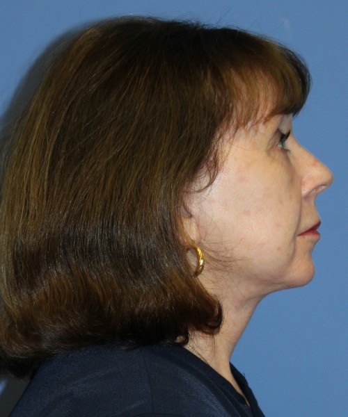Facelift, Browlift, Lip Augmentation, Blepharoplasty 5033 – Click HERE for more views after photo. Individual results may vary.