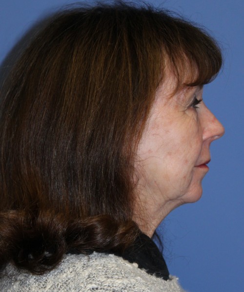 Facelift, Browlift, Lip Augmentation, Blepharoplasty 5033 – Click HERE for more views before photo. Individual results may vary.