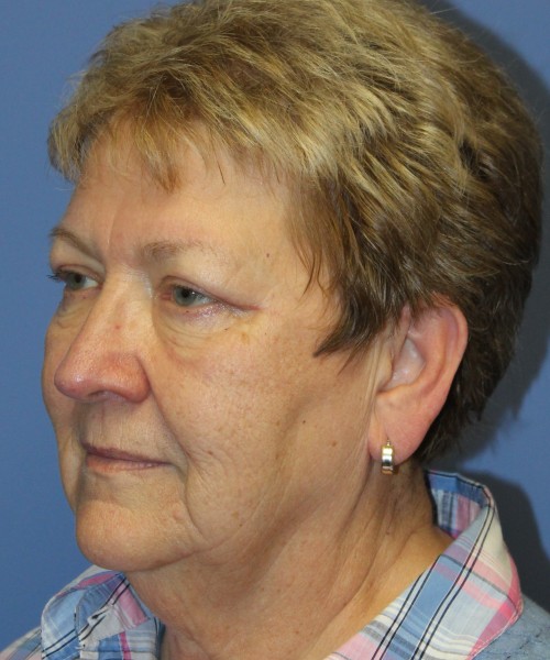 Blepharoplasty (Eyelids) 5044 – Click HERE for more views after photo. Individual results may vary.