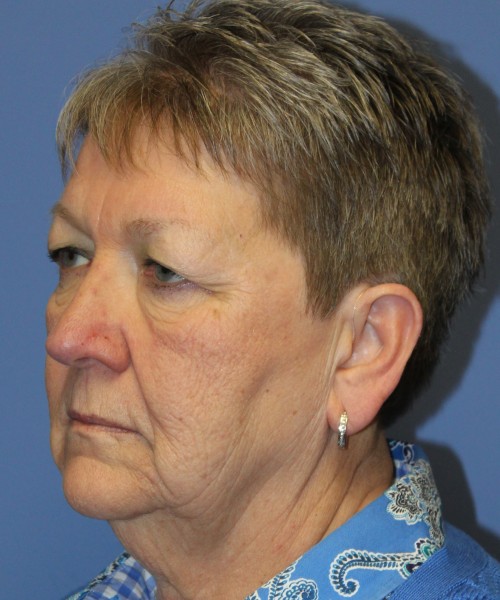 Blepharoplasty (Eyelids) 5044 – Click HERE for more views before photo. Individual results may vary.