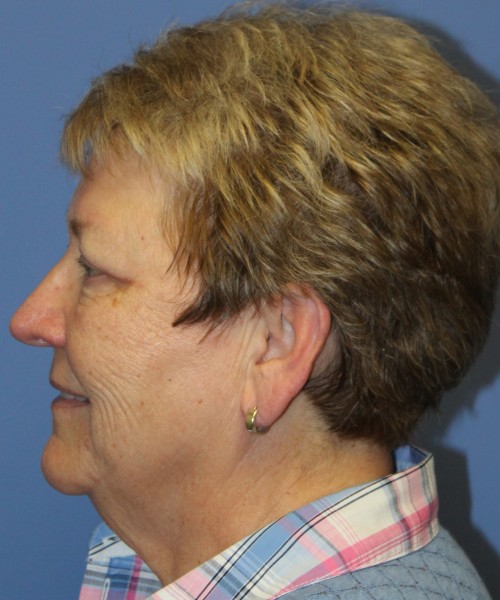 Blepharoplasty (Eyelids) 5044 – Click HERE for more views after photo. Individual results may vary.