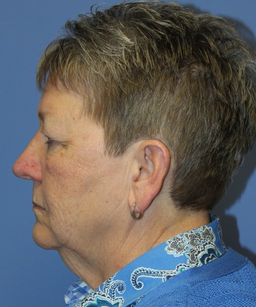 Blepharoplasty (Eyelids) 5044 – Click HERE for more views before photo. Individual results may vary.