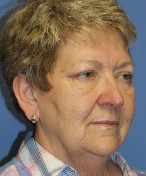 Blepharoplasty (Eyelids) 5044 – Click HERE for more views after photo. Individual results may vary.