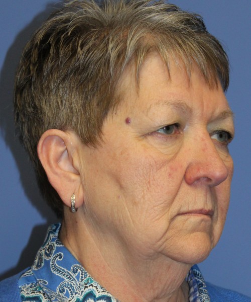 Blepharoplasty (Eyelids) 5044 – Click HERE for more views before photo. Individual results may vary.