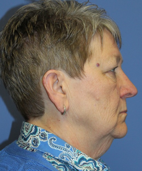 Blepharoplasty (Eyelids) 5044 – Click HERE for more views before photo. Individual results may vary.