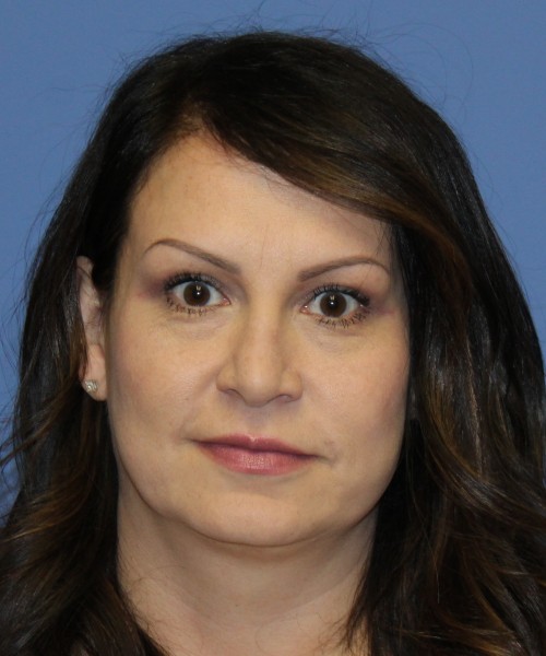 Blepharoplasty (eyelids) 5056 – Click HERE for more views after photo. Individual results may vary.