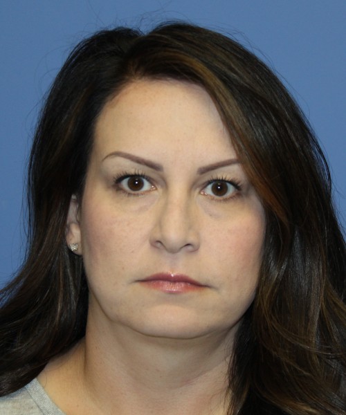 Blepharoplasty (eyelids) 5056 – Click HERE for more views before photo. Individual results may vary.