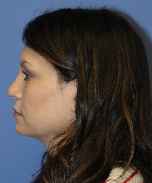 Blepharoplasty (eyelids) 5056 – Click HERE for more views after photo. Individual results may vary.