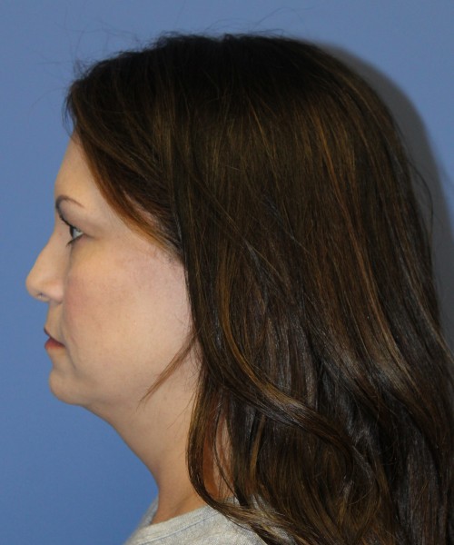 Blepharoplasty (eyelids) 5056 – Click HERE for more views before photo. Individual results may vary.