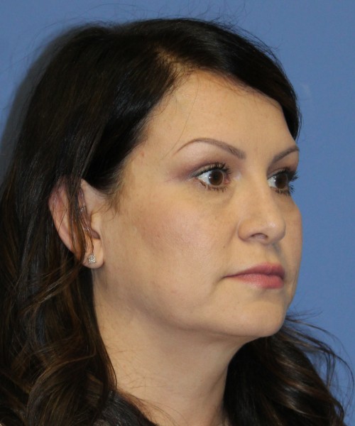 Blepharoplasty (eyelids) 5056 – Click HERE for more views after photo. Individual results may vary.