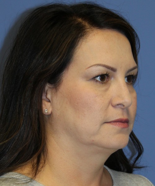 Blepharoplasty (eyelids) 5056 – Click HERE for more views before photo. Individual results may vary.