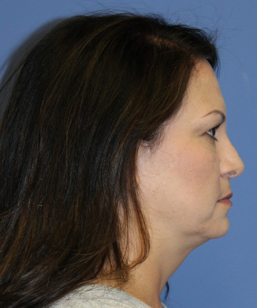 Blepharoplasty (eyelids) 5056 – Click HERE for more views before photo. Individual results may vary.