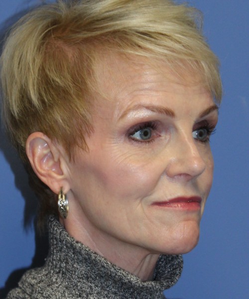 Rhinoplasty 5078 – Click HERE for more views after photo. Individual results may vary.