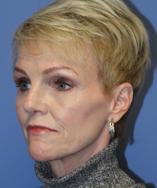 Rhinoplasty 5078 – Click HERE for more views after photo. Individual results may vary.