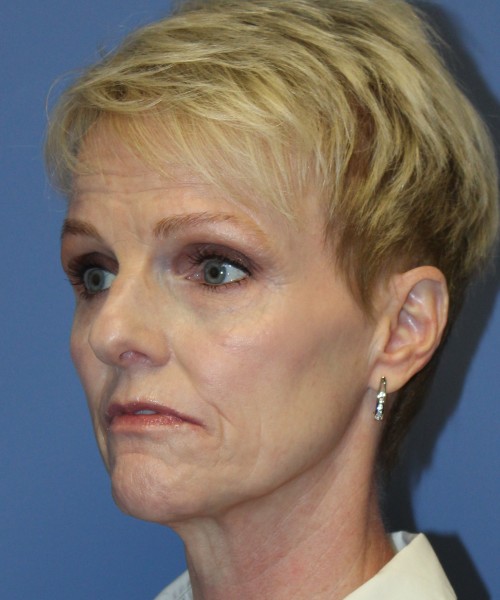 Rhinoplasty 5078 – Click HERE for more views before photo. Individual results may vary.